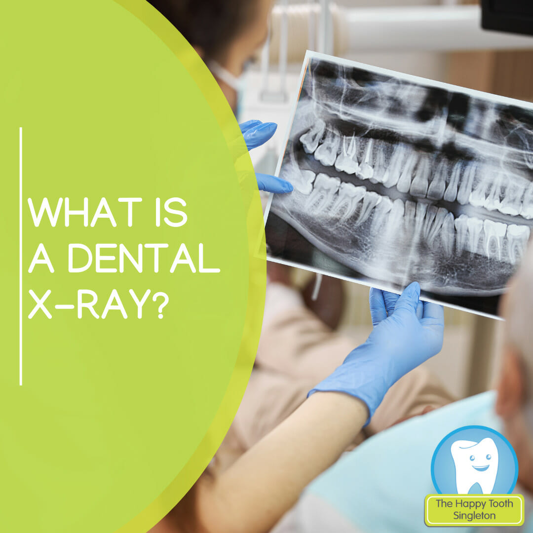 Dental Xrays The Happy Tooth Singleton