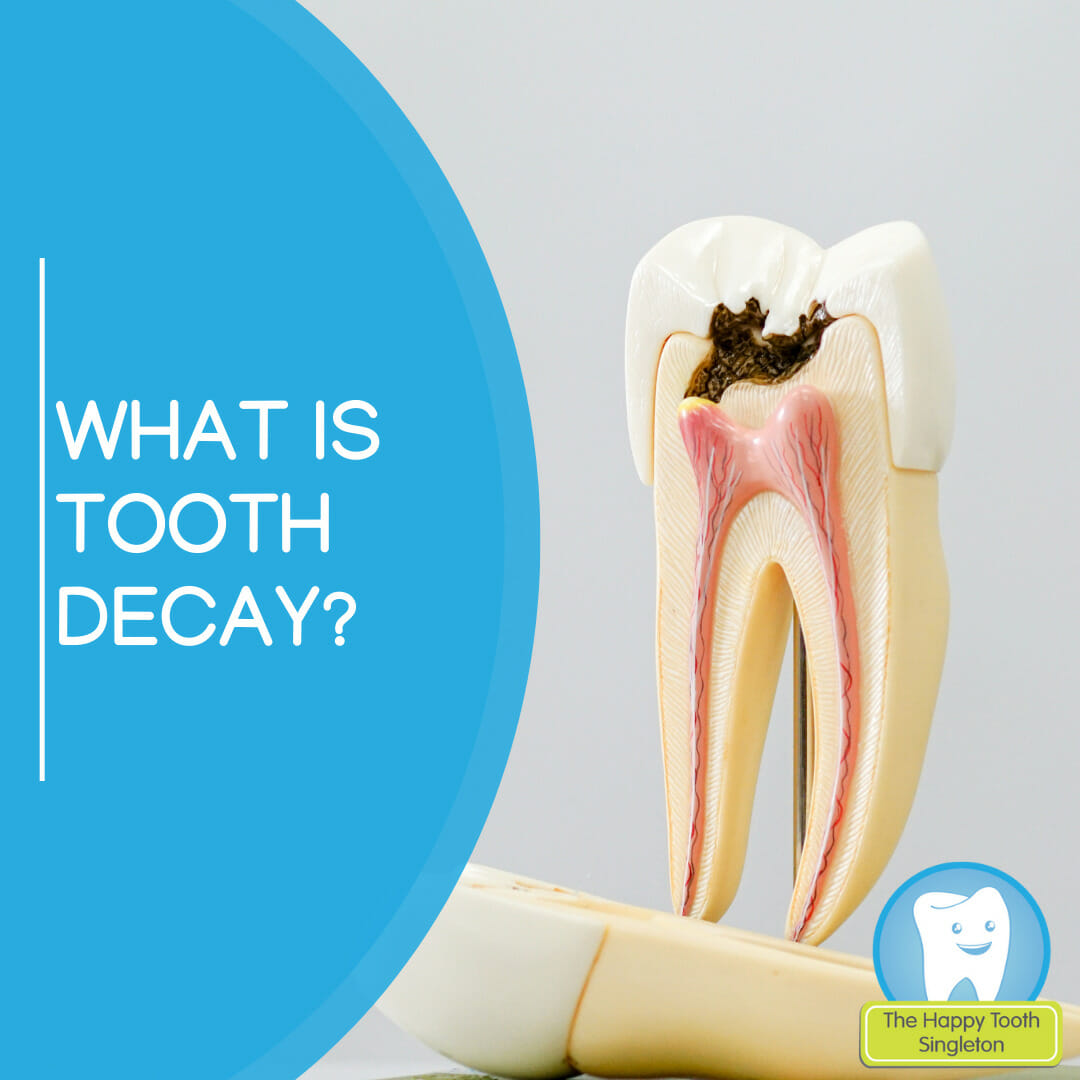 Tooth Decay The Happy Tooth Singleton