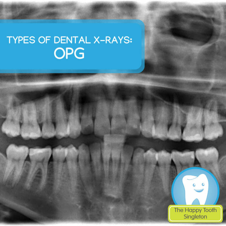 Types of dental xrays OPG The Happy Tooth Singleton