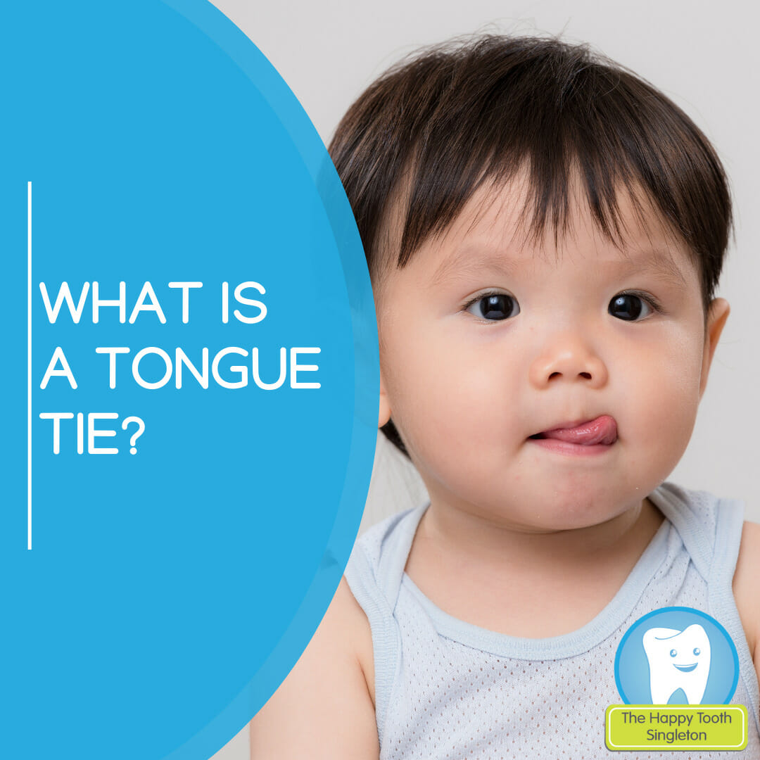 What is a Tongue tie? | The Happy Tooth Singleton