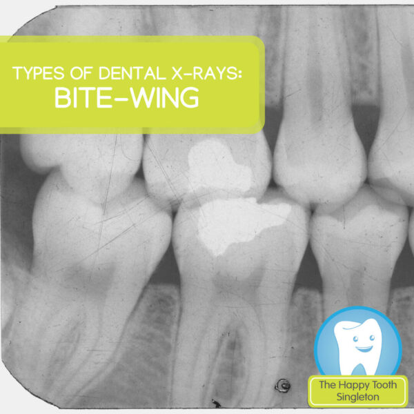 Bite-wing x-rays